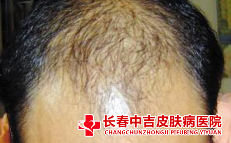 患者应该怎么治疗脱发