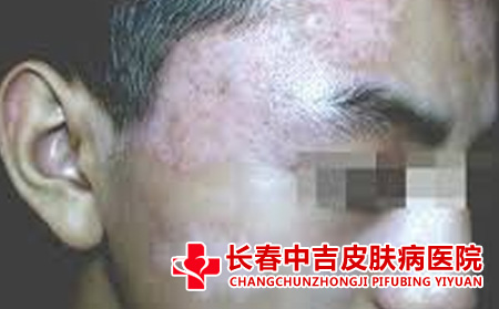 哪个医院治疗治疗白癜风