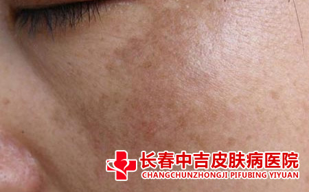 黄褐斑患者应该怎么进行治疗