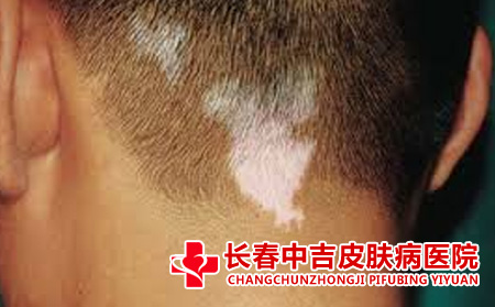 白斑的病症表现