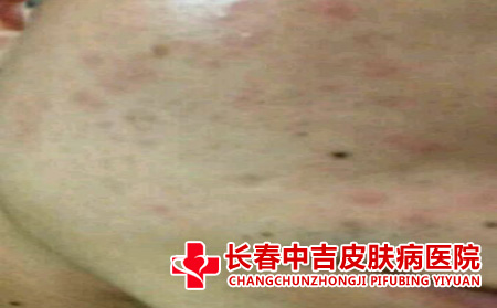 毛囊炎病症