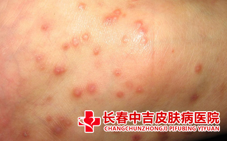 湿疹患者应该怎么进行治疗