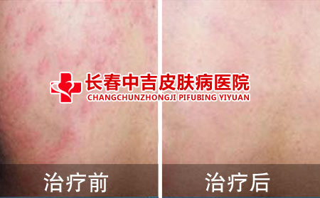 湿疹治疗前后对比