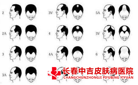 毛囊炎脱发
