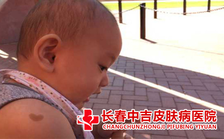 心形胎记