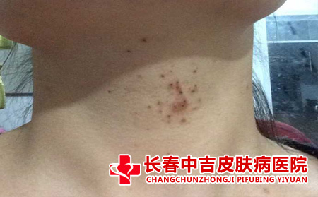 脖子部位的扁平庞