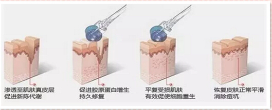瘢痕体质