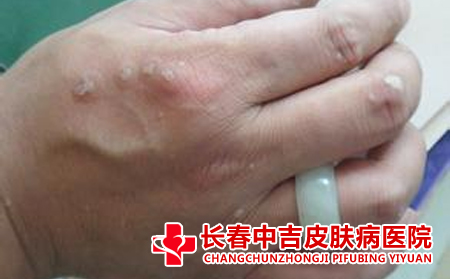 扁平庞治疗其他方