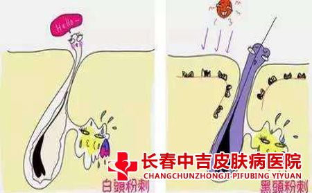 闭合性粉刺如何积极应对