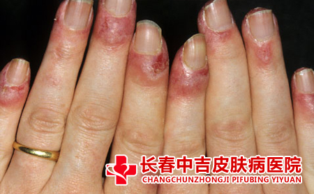 红斑狼疮病症