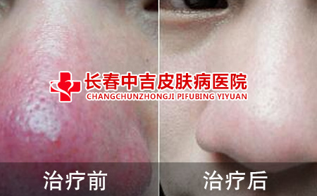 酒槽鼻治疗前后对比