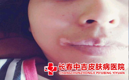 皮肤白斑