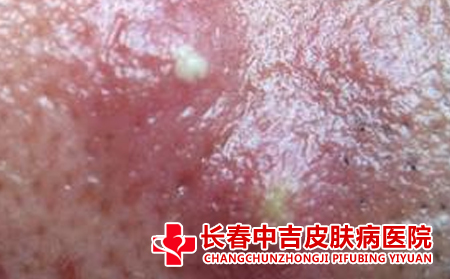 毛囊炎症状