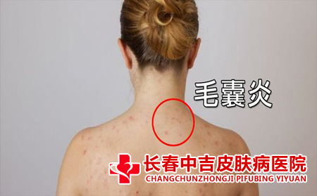 后背的毛囊炎越来越严重