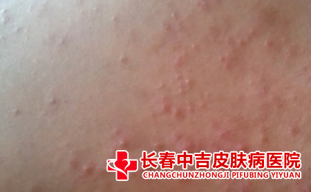 湿疹如何缓解