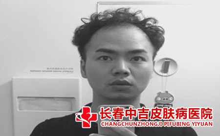 严重的脱发情况