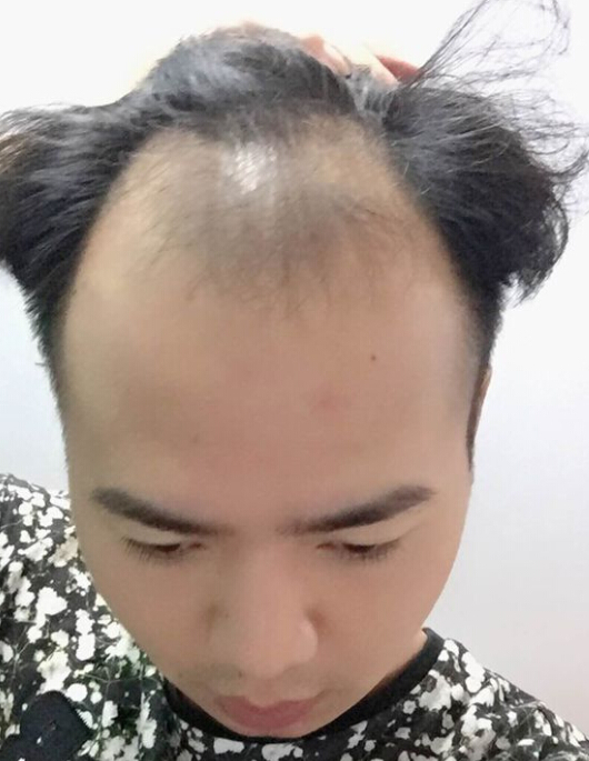 头顶快成秃子了