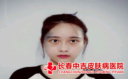 从小就因为胎记而自卑