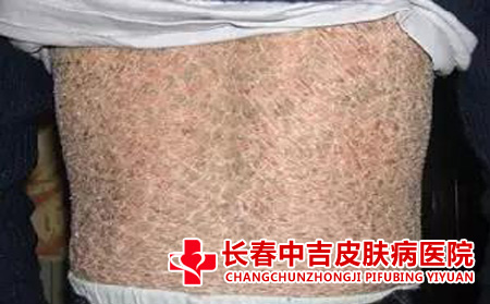 后背扁平庞病症