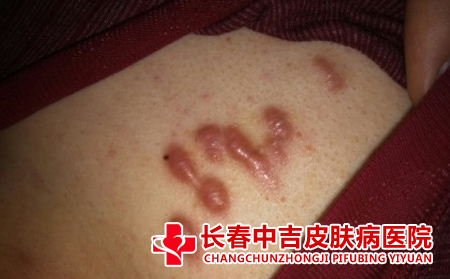 增生的瘢痕如何去除