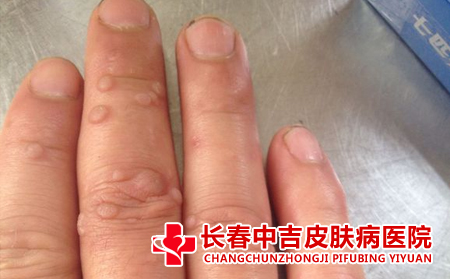 扁平庞治疗方法