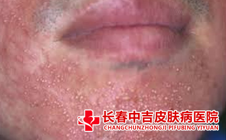 脸上的痘痘总是控制不住的长