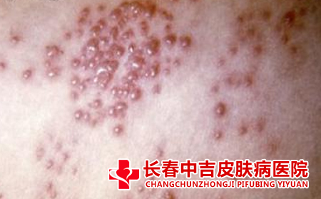 疱疹症状