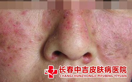 系统性红斑狼疮