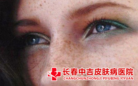 面部黄褐斑中医疗法