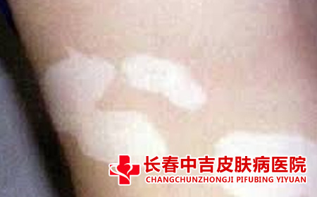 白癜风怎么治疗比较不错