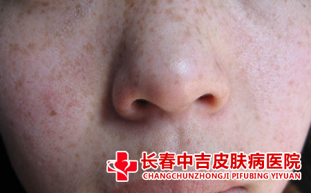 雀斑的治疗方法