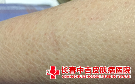 鱼鳞病哪里治疗合适