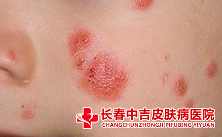 少女牛皮癣的原因
