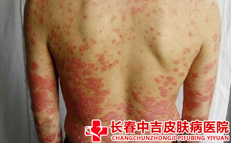 牛皮癣秋冬季节重的原因