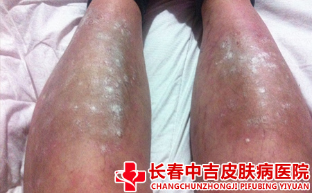 牛皮癣变化的原因