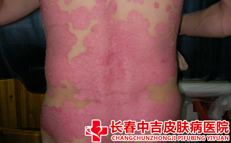 牛皮癣的诱因有什么