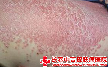 秋冬牛皮癣的原因有什么