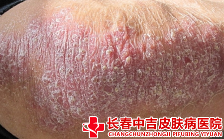牛皮癣的症状有什么