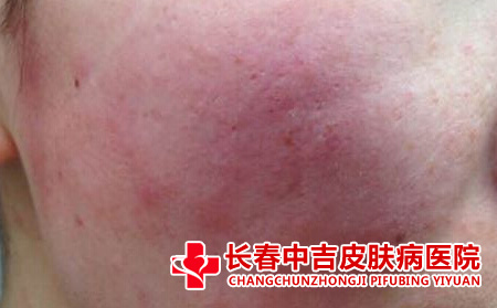 脸部牛皮癣的症状