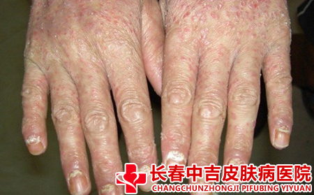 牛皮癣的症状有什么