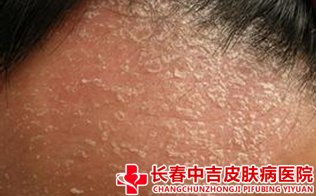 头部牛皮癣的症状