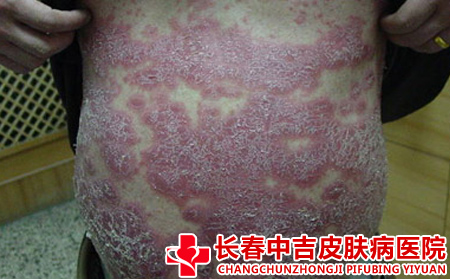 血热型牛皮癣的症状