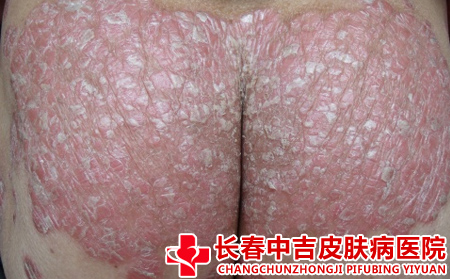 牛皮癣症状图片