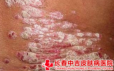 秋冬牛皮癣怎么护理