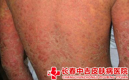 牛皮癣怎么预防加重