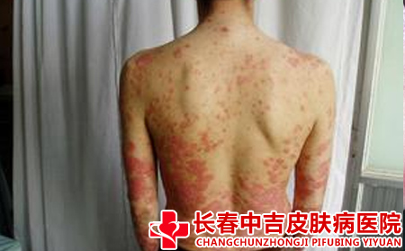 牛皮癣要怎么护理