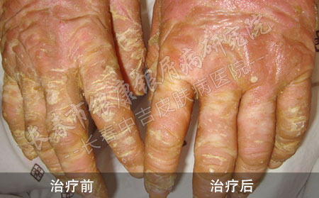 如何治牛皮癣