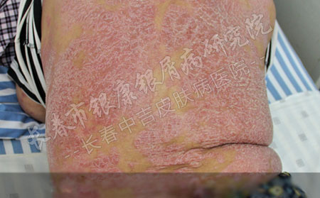 牛皮癣中药治疗