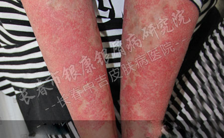 牛皮癣长什么样