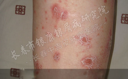 长春哪个医院治牛皮癣